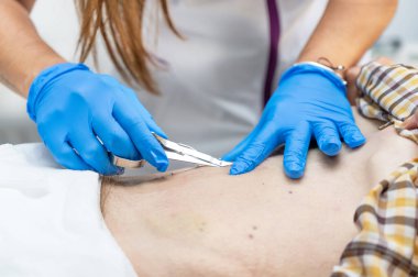 Cerrahi müdahaleden sonra bir hastanın karnındaki cerrahi dikişleri alan hemşire. Yüksek kalite fotoğraf