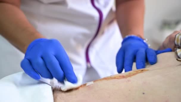 Primer Plano Las Enfermeras Mano Limpia Trata Lesión Abdominal Después — Vídeo de stock