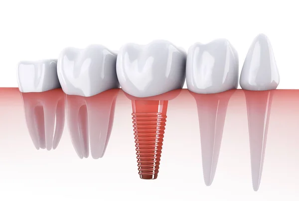 Molars Implantaat Het Kaakbot Renderen — Stockfoto