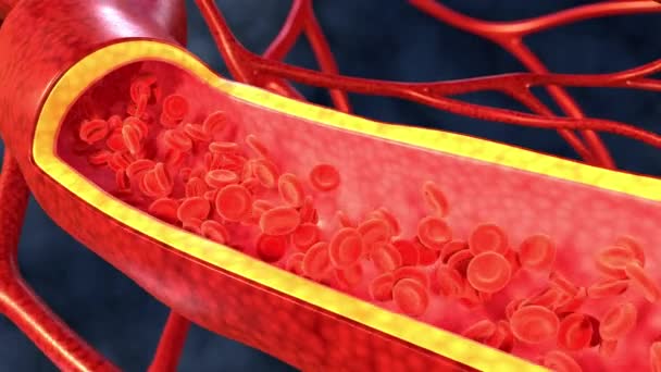 Flöde Röda Blodkroppar Ett Blodkärl Närbild Växande Kolesterolplack Väggen Ett — Stockvideo