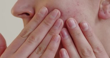 Close up view of woman acne skin caused by hormone. Red rash on young woman face, Itchy and allergic skin problems, dermatitis 