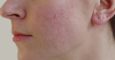 Close up view of woman acne skin caused by hormone. Red rash on young woman face, Itchy and allergic skin problems, dermatitis 