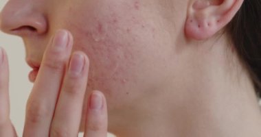 Cropped view of the teen woman touching acne pores on the skin of her face. Cleansing the face skin concept 