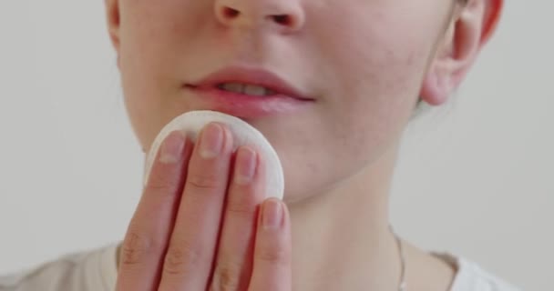 Cropped View Teen Girl Problem Skin Applying Treatment Cream White — Stok video