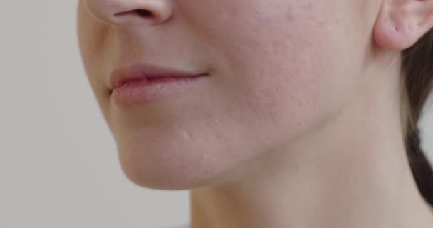 Sivilce Sorunu Hatunlara Sivilceli Bir Kadın Yüzü Vardı Kozmetik Cilt — Stok video