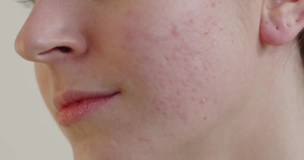 问题皮肤 近视年轻女子触摸脸上有毛孔的痤疮皮肤 皮肤科问题概念 — 图库视频影像