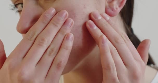 Retrato Mulher Com Inflamação Acne Rosto Corpo Vista Cortada Menina — Vídeo de Stock