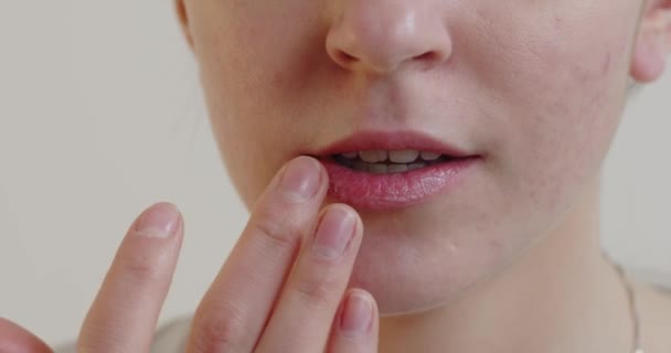 Cropped Shot Young Womans Face Touching Acne Face Pimples Red — Stockvideo