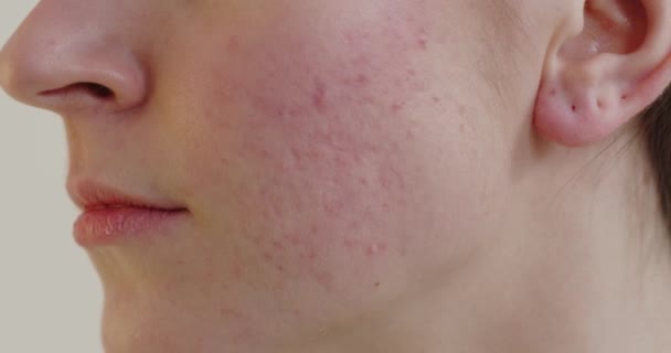 近距离观察女性因荷尔蒙引起的痤疮皮肤 年轻女人脸上的红疹 瘙痒和过敏的皮肤问题 — 图库视频影像