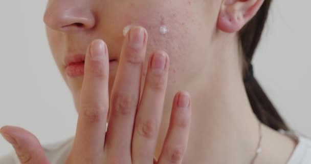 白い背景に治療クリームを塗る問題肌の10代の女の子のクロップビュー スキンケアコンセプト — ストック動画