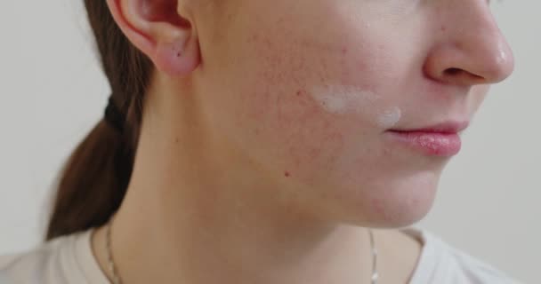 用白色背景涂上治疗霜的少女问题皮肤的剪影 皮肤护理概念 — 图库视频影像