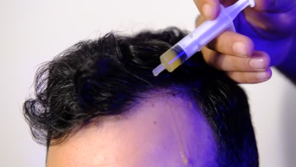 Чоловіча Концепція Доглядом Волоссям Хімічна Речовина Яка Використовується Запобігання Облисіння — стокове відео