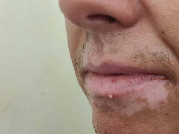 woman\'s lips with pimples on the face