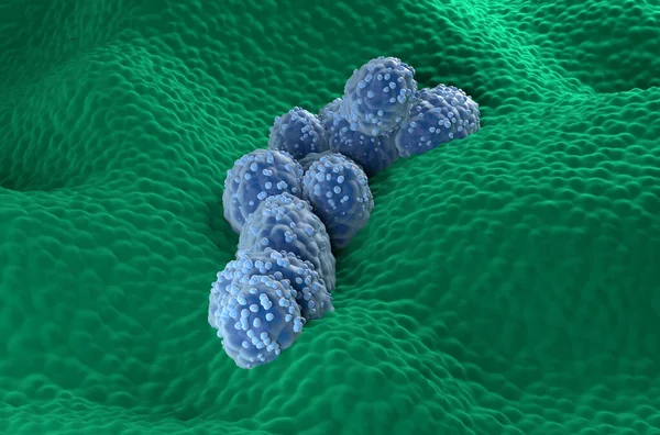 Prostate cancer cells in the prostatic glandular epithelium - front view 3d illustration