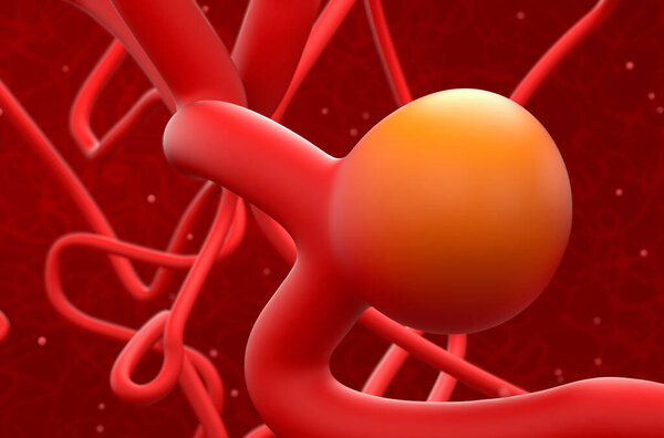 Brain artery aneurysm (Cerebral Aneurysm) - 3d illustration closeup view