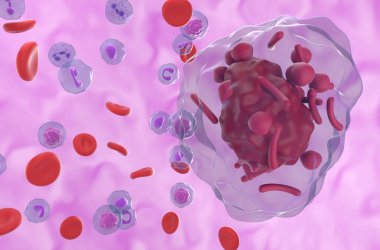 Akut Promielositik Lösemi (APL) - 3d illüstrasyon yakın görüntüsü