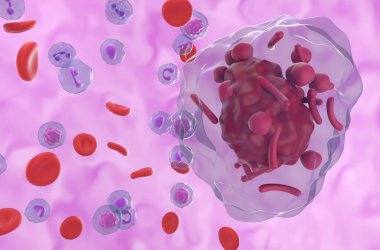 Auer rods (or Auer bodies) in acute Hypergranular Promyelocytic Leukemia (APL) - 3d illustration closeup view clipart