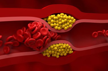 Fully blocked vessel in high level of LDL (bad cholesterol) lipoprotein  Closeup view 3d illustration clipart