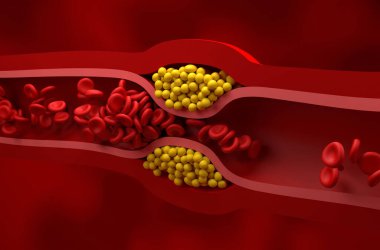 Kısmen engellenmiş damar yüksek seviyede LDL (kötü kolesterol) lipoprotein izometrik görünüm 3d illüstrasyon