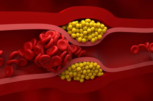 Yüksek seviyede LDL (kötü kolesterol) lipoprotein Kapanış Görünümü 3d illüstrasyonunda tam tıkanmış damar