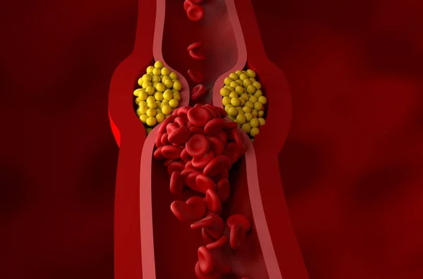 Ön görünümde kısmen engellenmiş LDL (kötü kolesterol) lipoproteol 3d illüstrasyon