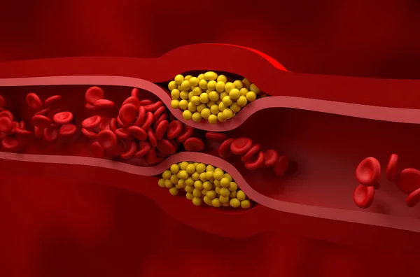 Kısmen engellenmiş damar yüksek seviyede LDL (kötü kolesterol) lipoprotein izometrik görünüm 3d illüstrasyon