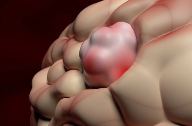 Meningioma (brain cancer) tumor in the brain tissue - 3d illustration closeup view clipart