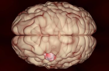 Meningioma (brain cancer) tumor in the brain tissue - 3d illustration top view clipart