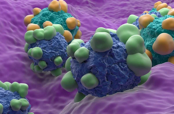 Adenocarcinoma cancer cells in the human body - closeup view 3d illustration