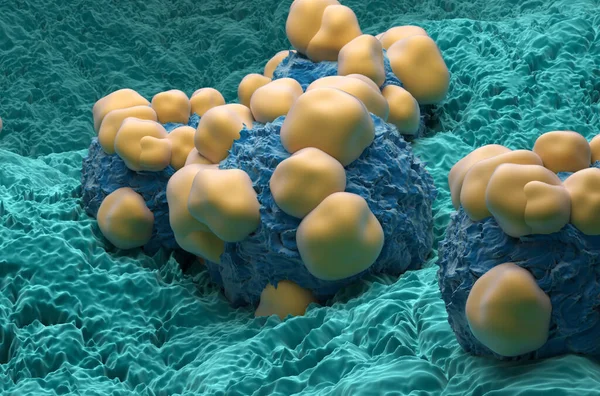 Аденокарцинома Раковые Клетки Организме Человека Взгляд Крупным Планом Иллюстрации — стоковое фото