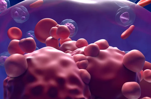 Οξεία Λεμφοβλαστική Λευχαιμία All Καρκινικά Κύτταρα Στη Ροή Του Αίματος — Φωτογραφία Αρχείου