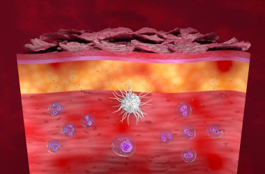 Egzama 'da iltihaplı deri, Atopic Dermatitis (AD) - izometrik görünüm 3d illüstrasyon