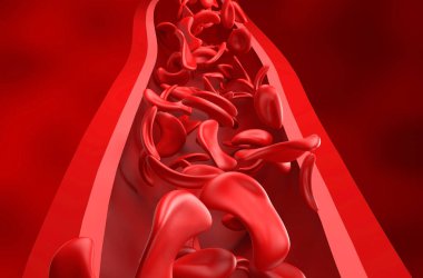 Sickle cell anaemia - front view 3d illustration clipart