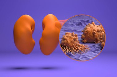 Böbrek kanseri - izometrik görünüm 3D illüstrasyon