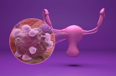 Ovarian cancer - isometric view 3d illustration clipart