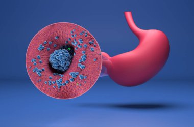 Stomach cancer (gastric) - isometric view 3d illustration