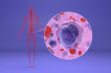 Acute myeloid leukemia (AML) - isometric view 3d illustration clipart