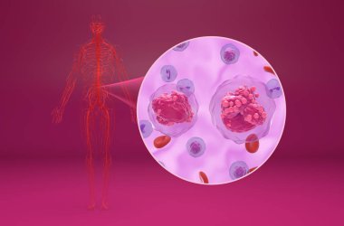 Akut lenfositik lösemi (All) - izometrik görünüm 3d illüstrasyon