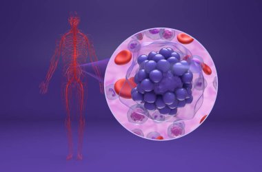 Geniş B hücreli lenfoma (DLBCL) - izometrik görünüm 3d illüstrasyon