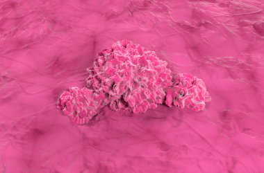 Mesane kanseri - izometrik görünüm 3D illüstrasyon