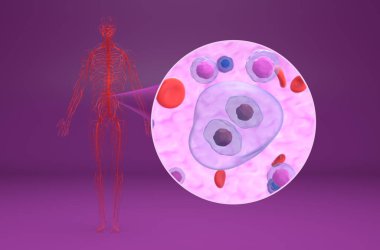 Kan akışındaki Hodgkin lenfoması (HL) hücreleri - izometrik görünüm 3d illüstrasyon