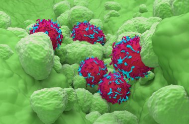 Akciğer dokusunda Küçük Hücre Akciğeri Kanseri (NSCLC) - Süper yakın çekim 3d illüstrasyon