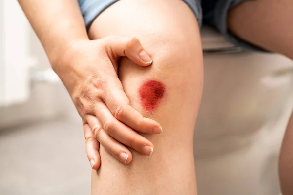 Fechar Pernas Uma Mulher Sentada Banheiro Com Uma Ferida Sangrenta — Fotografia de Stock