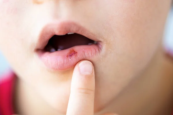 Bambino Toccare Una Lesione Sanguinosa Sul Labbro Con Dito — Foto Stock