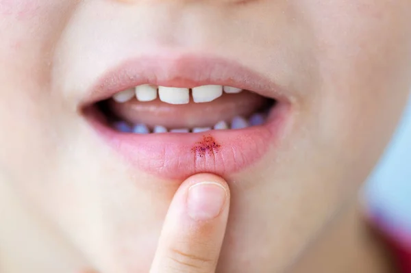 子供は口の中でアフサ性潰瘍や癌の痛みを持っている唇 — ストック写真