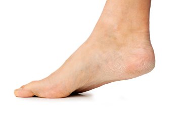 Cropped shot of a bare foot with cracked heel skin