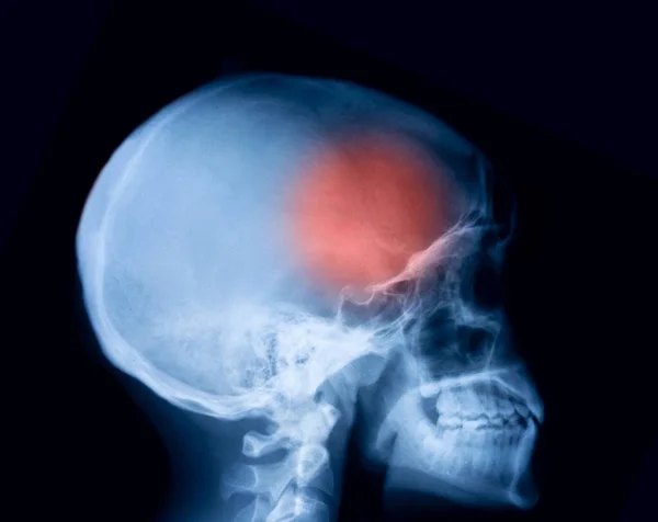 X-ray of brain and skull skeleton. Headache, meningitis and migraine concept