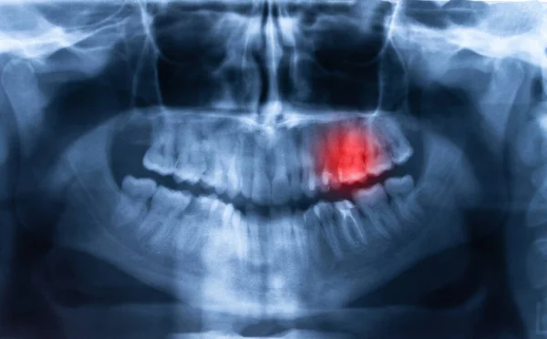 Close-up At Teeth X-ray