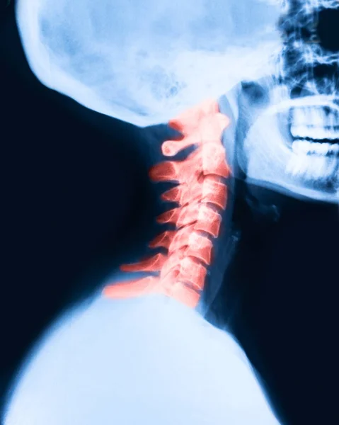 Close up of xray of the cervical spine painful area