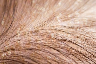 Newborn baby with psoriasis or dandruff in the hair
